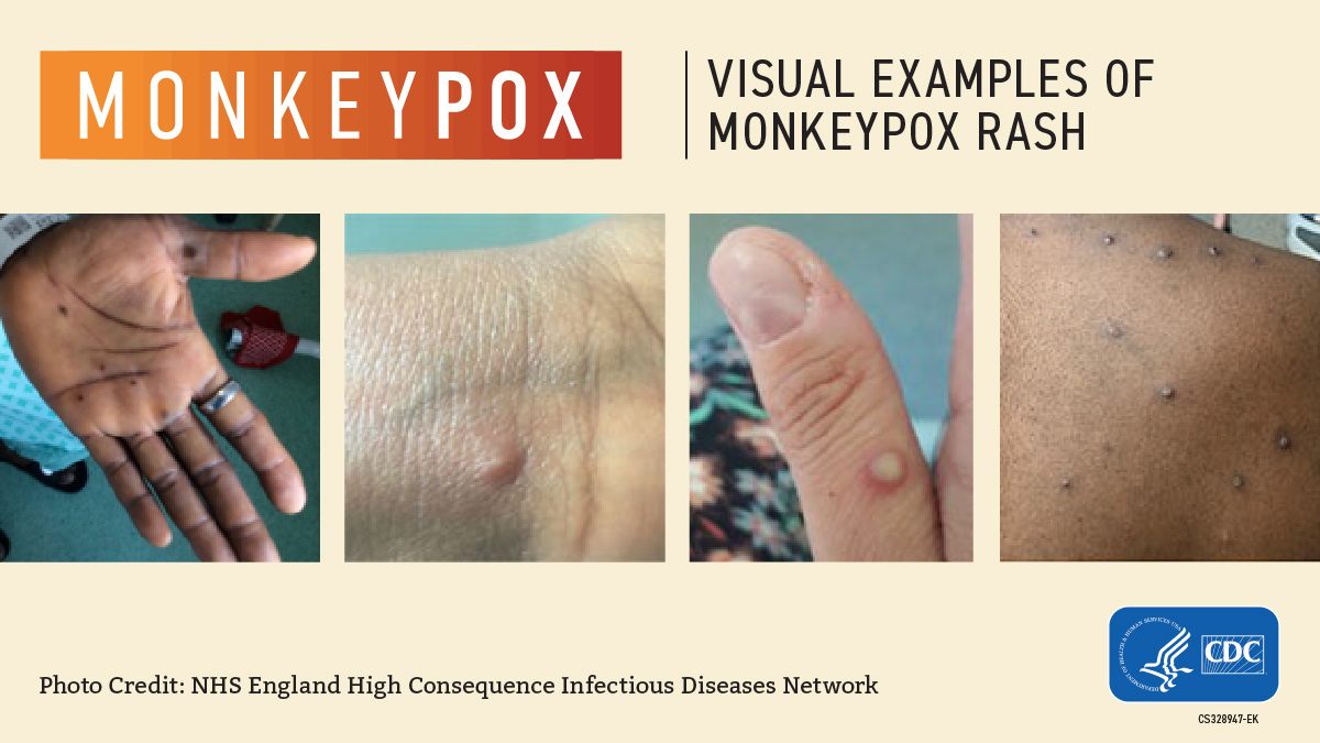 Four pictures of monkeypox rash on different body parts